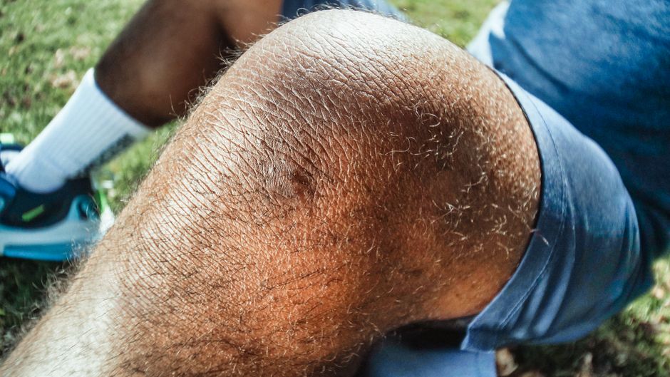 Detailed close-up of an injured knee with a bruise, captured outdoors in natural light.