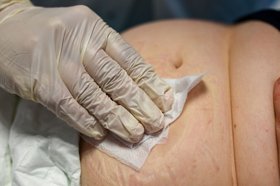 Close-up of a nurse cleaning a patient's ostomy area in a clinical setting.