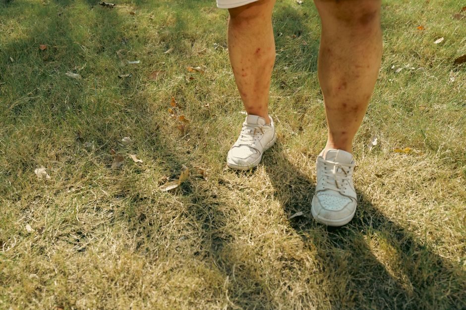 Close-up of a person's legs with scars on a grassy field during daytime.